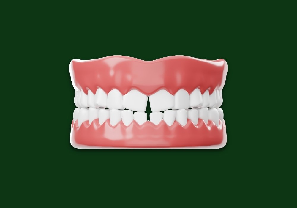 can invisalign close gaps in teeth