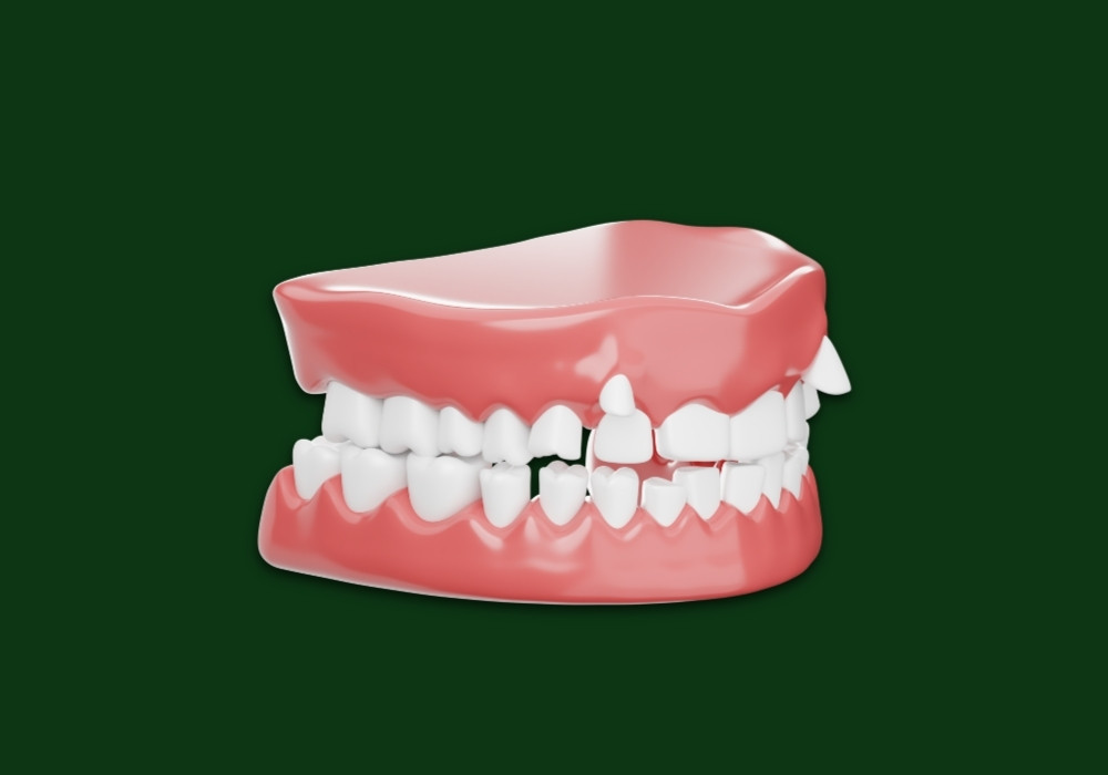 can invisalign straighten crooked teeth