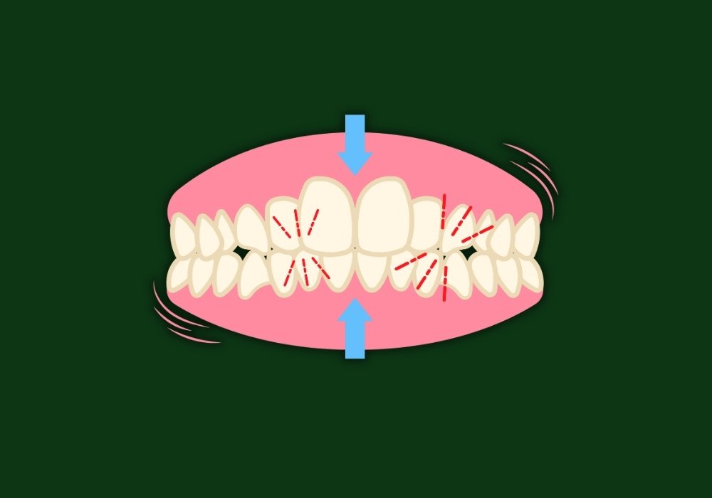 can invisalign fix overbite