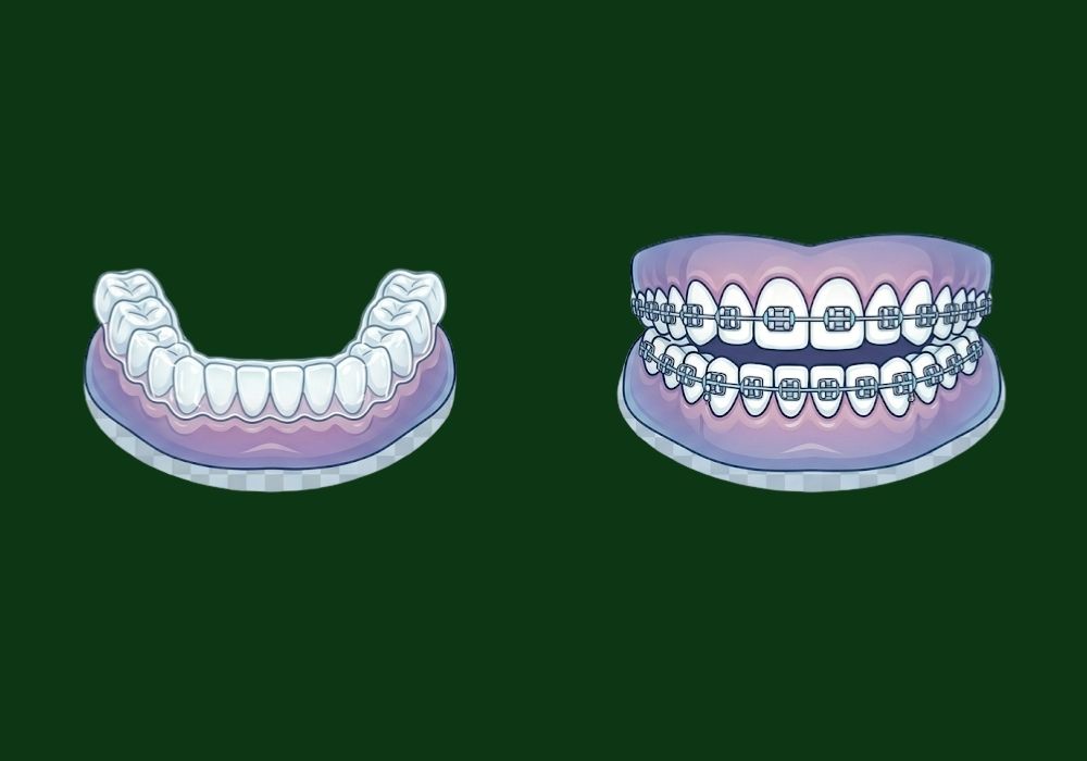 invisalign vs braces