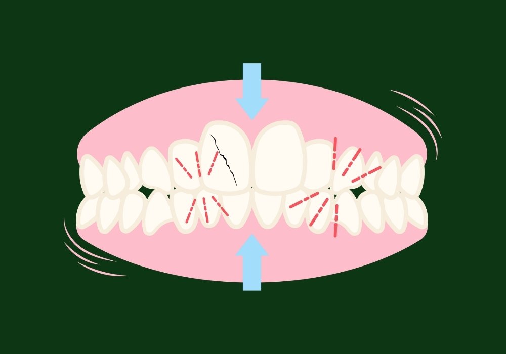 can teeth crack from clenching