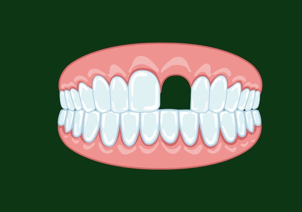 can you get veneers with a missing tooth
