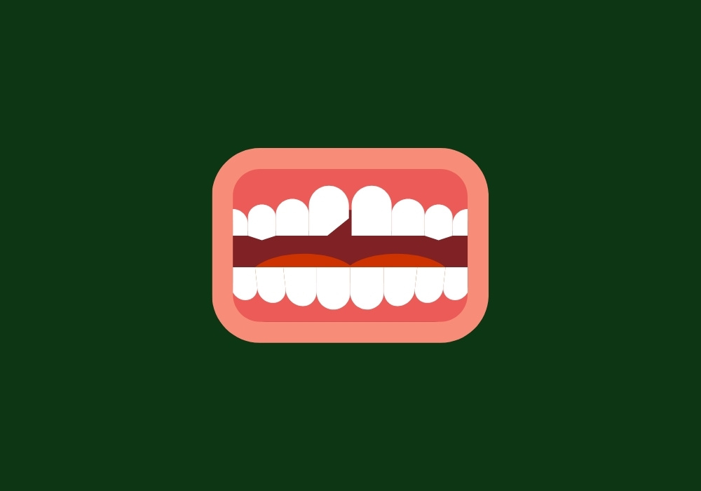 can you repair a chipped veneer tooth