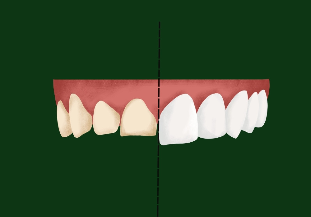 will veneers help tooth sensitivity