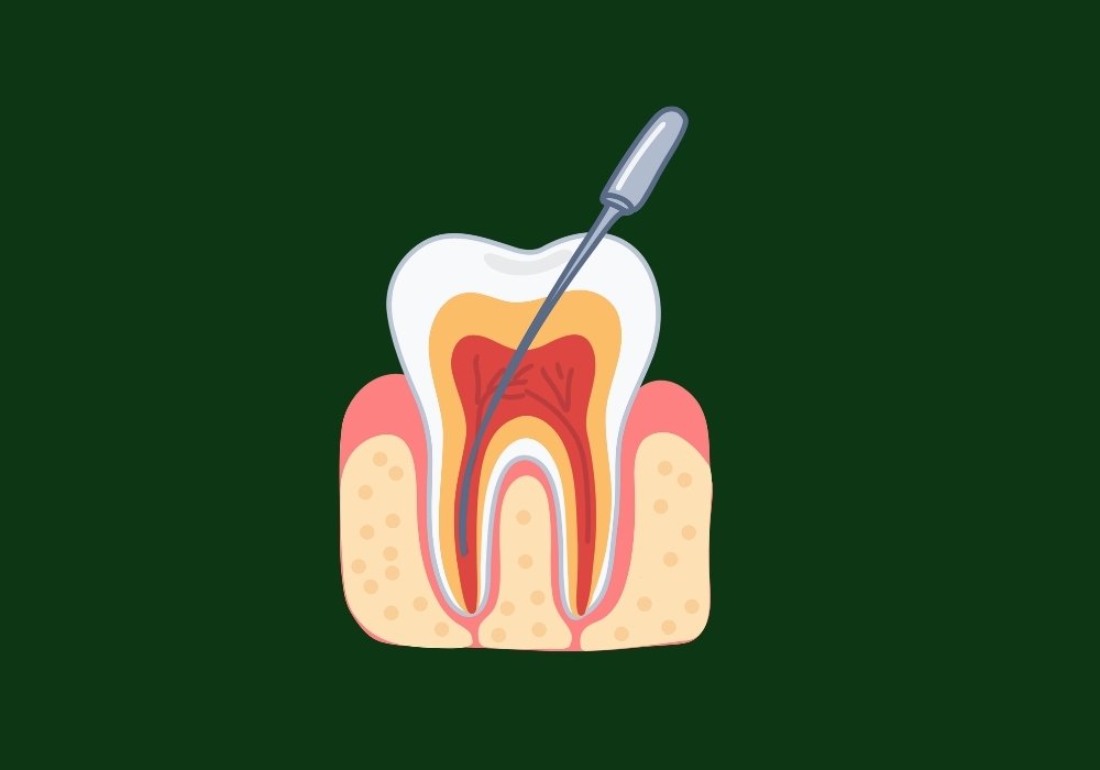 can a tooth get infected years after a root canal