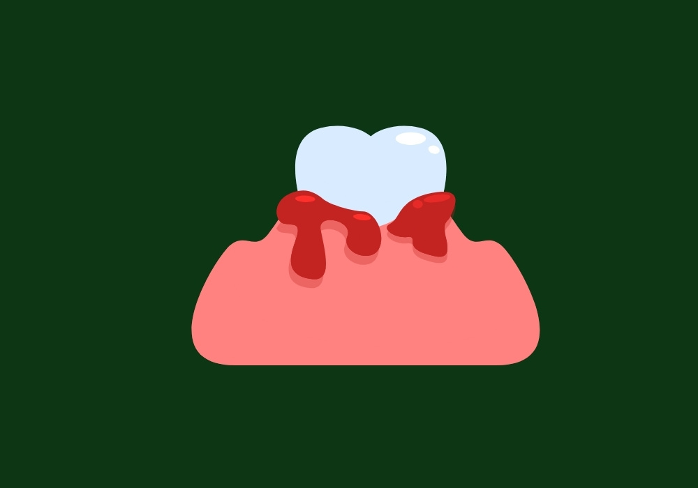 can b12 deficiency cause bleeding gums