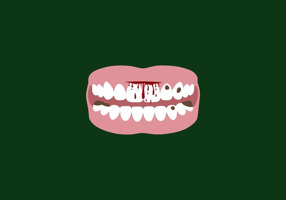 can cavity cause bleeding