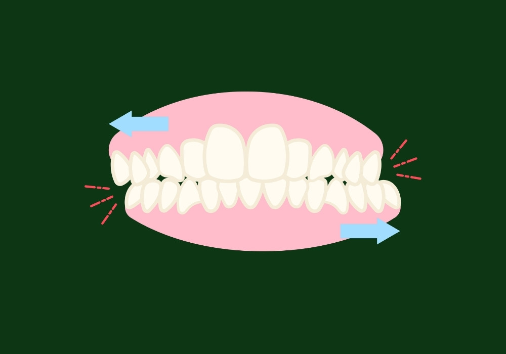 can clenching teeth cause swollen gums