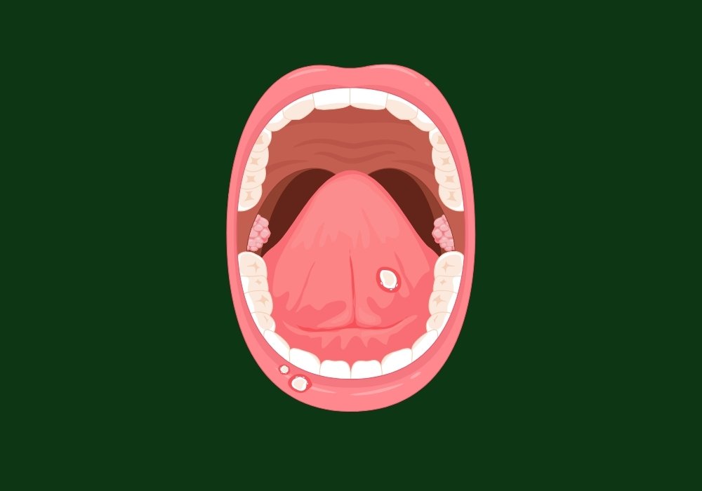 can gum disease causes ulcer