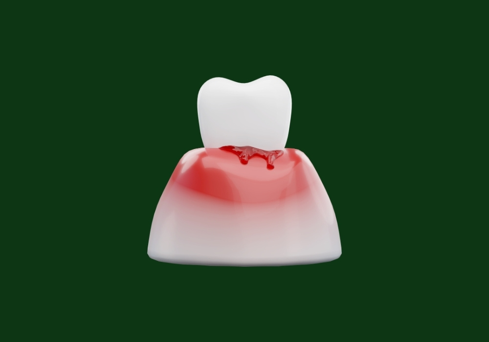 what deficiency causes gum bleed